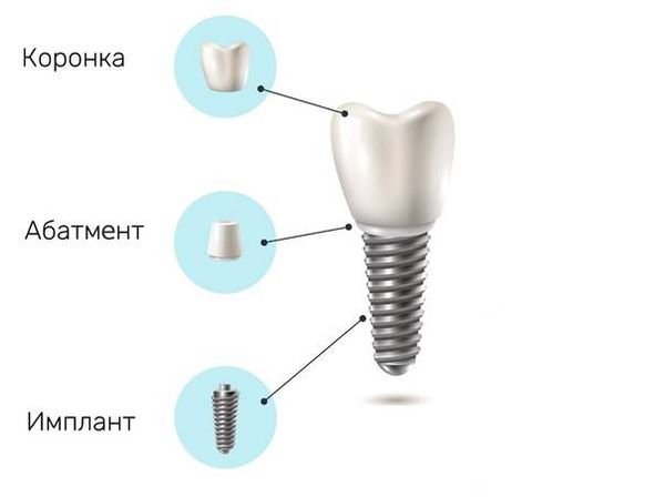 Имплант зуба фото из чего состоит